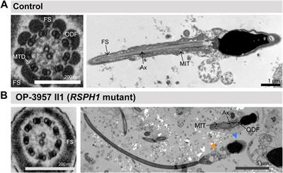 Pathogenic gene variants in CCDC39, CCDC40, RSPH1, RSPH9, HYDIN, and SPEF2 cause defects of sperm flagella composition and male infertility